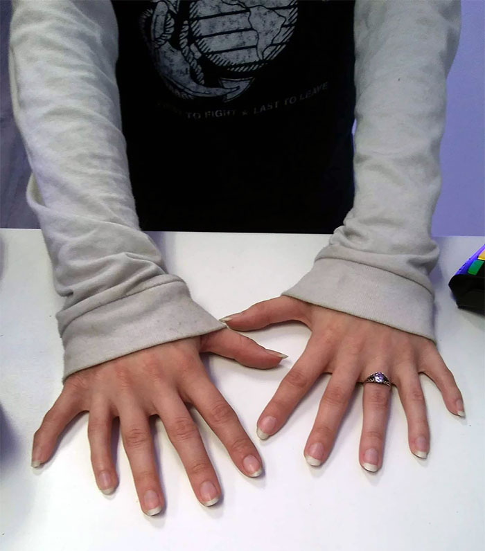 A person with 12 fingers on their hands