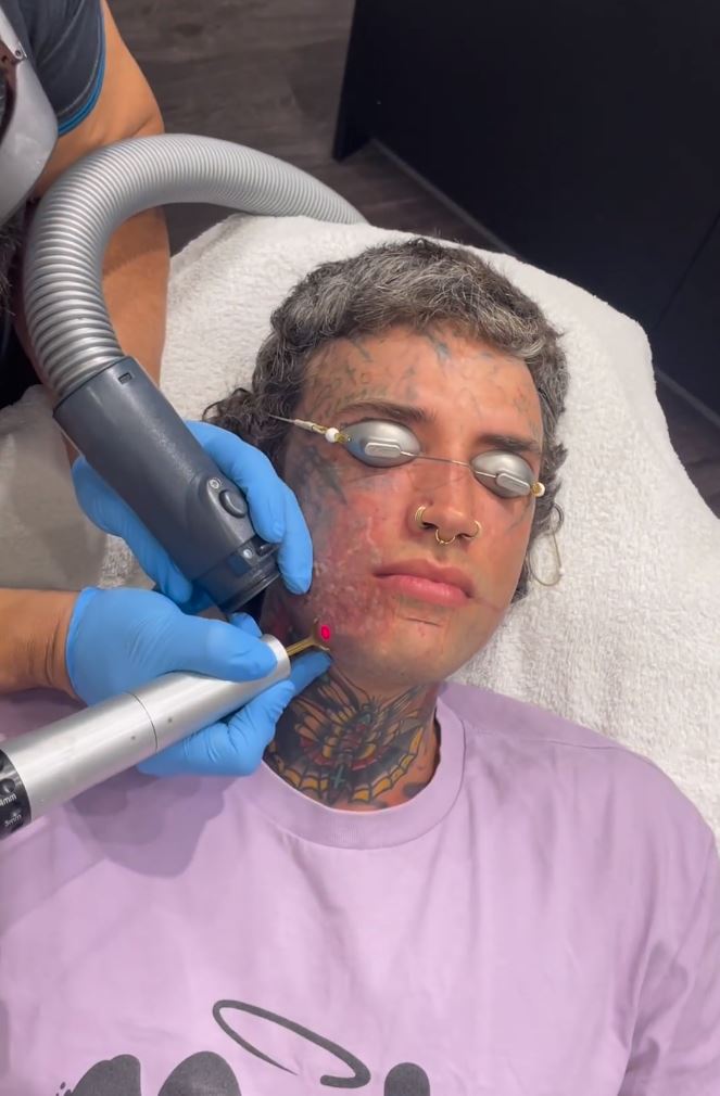 Man getting laser tattoo removal, wearing a light purple shirt