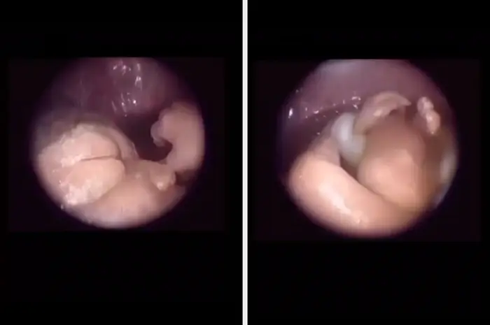 Endoscopic view of a fetus in the womb