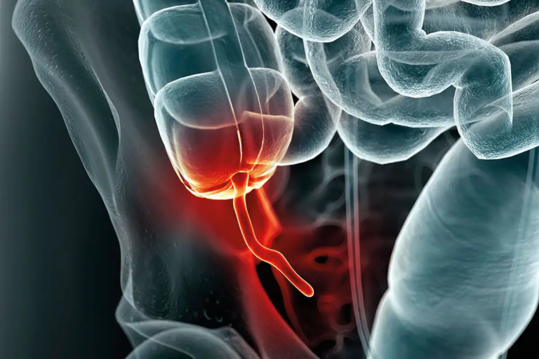 Parkinson’s disease may start in the appendix and travel to the brain - Featured image