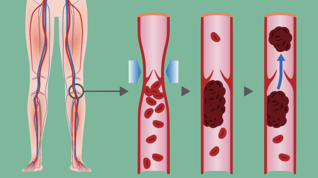 4 Warning Signs of a Blood Clot In Your Leg - Featured image