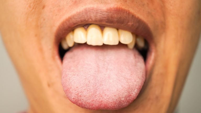 Why Cleaning Your Tongue Matters More Than You Think (It’s Not Just About Fresh Breath!) - Featured image