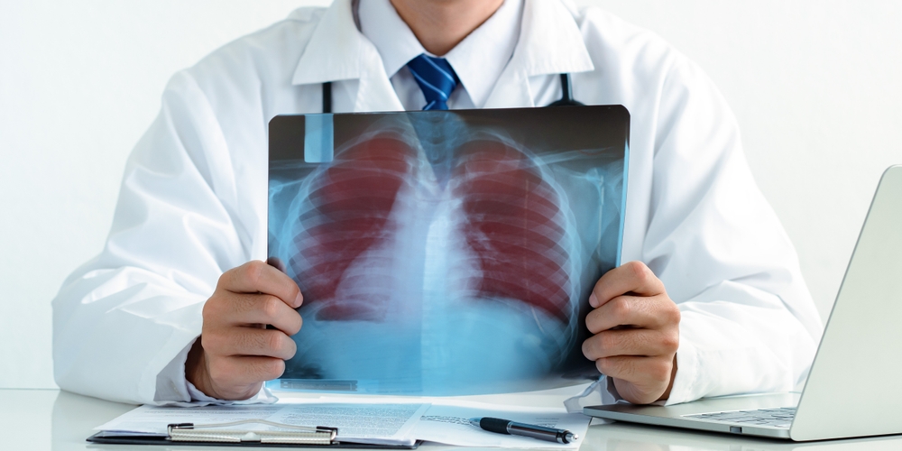 Doctor examining the patient chest x-ray film lungs scan in hospital. Lung problem. Lung Cancer or Pneumonia concept. copy space.