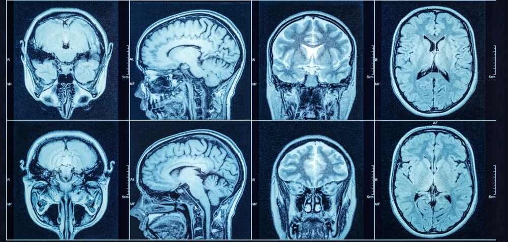 brain scan review