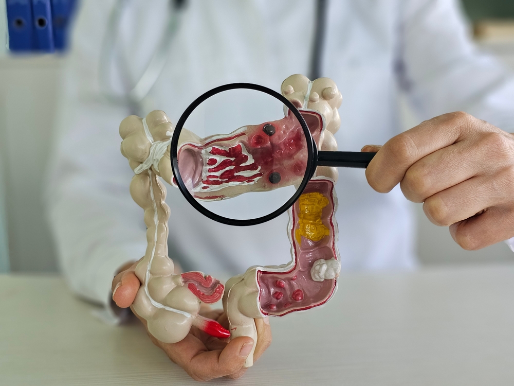 Magnifying glass and colon diseases and colorectal cancer and ulcerative colitis. Irritable bowel syndrome and digestive system