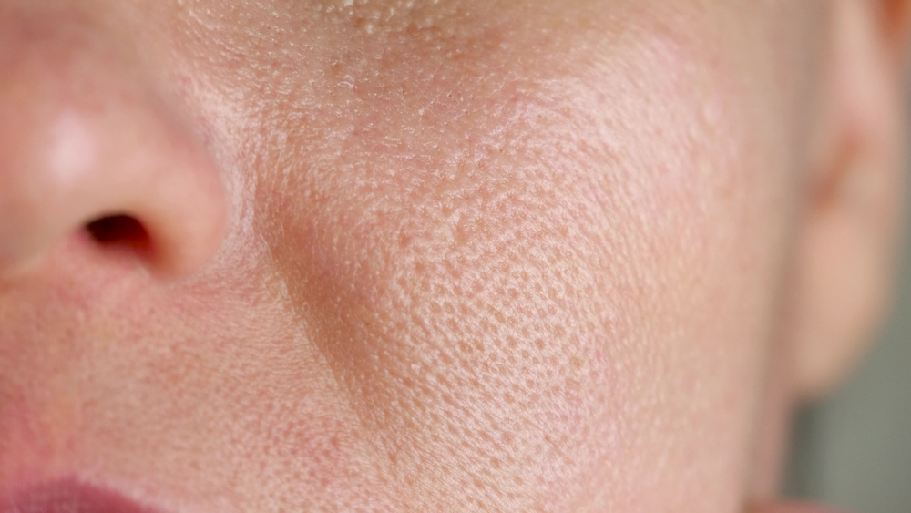skin texture on large pores. oily troubled facial skin close-up.