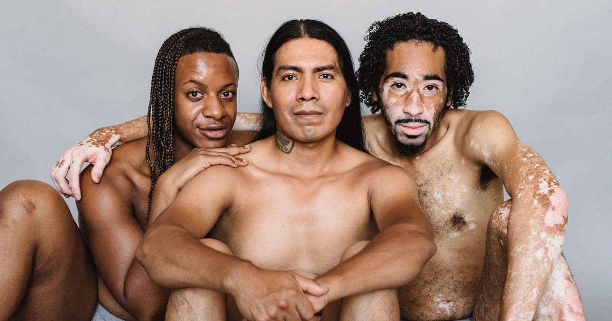 Content shirtless African American man living with vitiligo sitting on floor and hugging American Indian and black male friends with naked torso while looking at camera during photo session