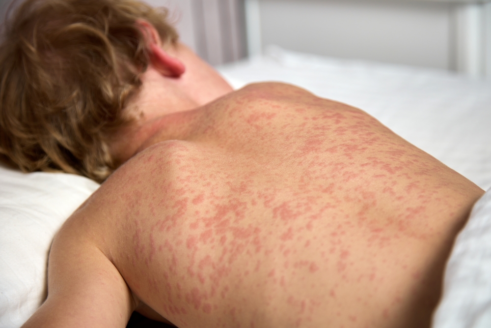 ‘This Might Be the Point of No Return’: Experts on the Current Measles Outbreak and Where We Go From Here - Featured image