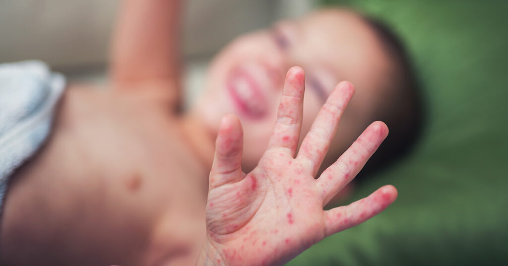 Measles Outbreaks Spread Across 41 States With Over 2,100 Cases - Featured image